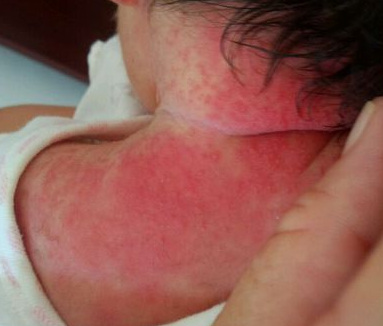 湿疹并不是简单的皮肤疾病