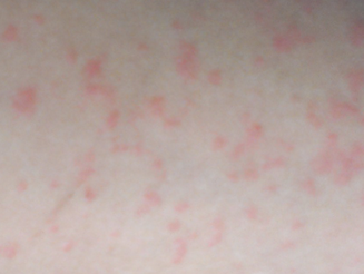 湿疹不治疗有哪些严重的危害？