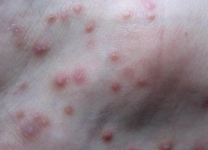 哪些原因引起湿疹？涡阳皮肤病医院？