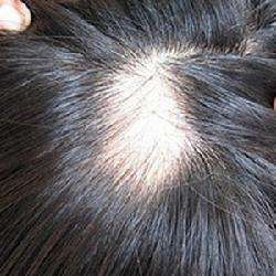 脂溢性脱发的发病原因有哪些